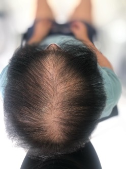 Alopecia androgenética feminina