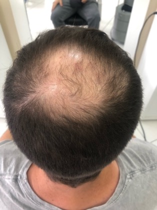 Alopecia androgenética masculina